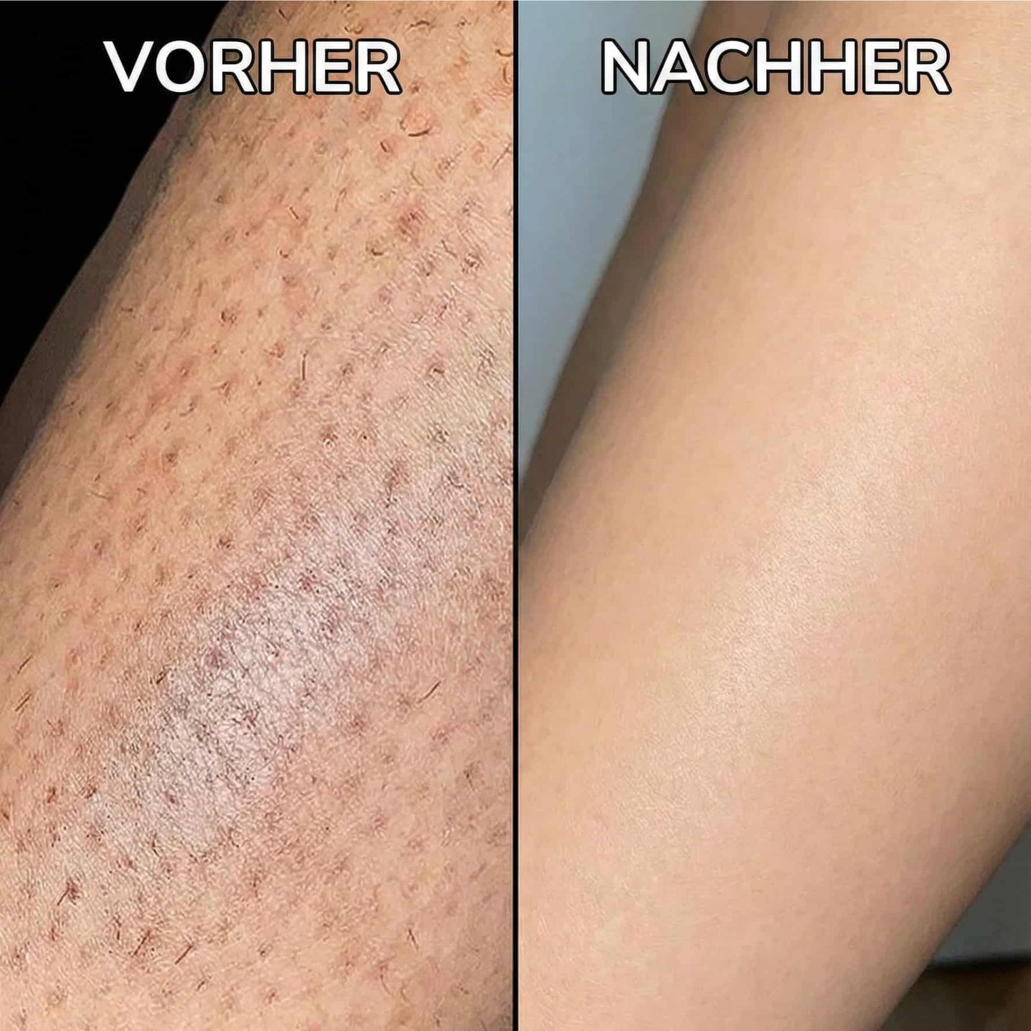 Veluna™ | Pflanzlicher Haarwuchsstopp