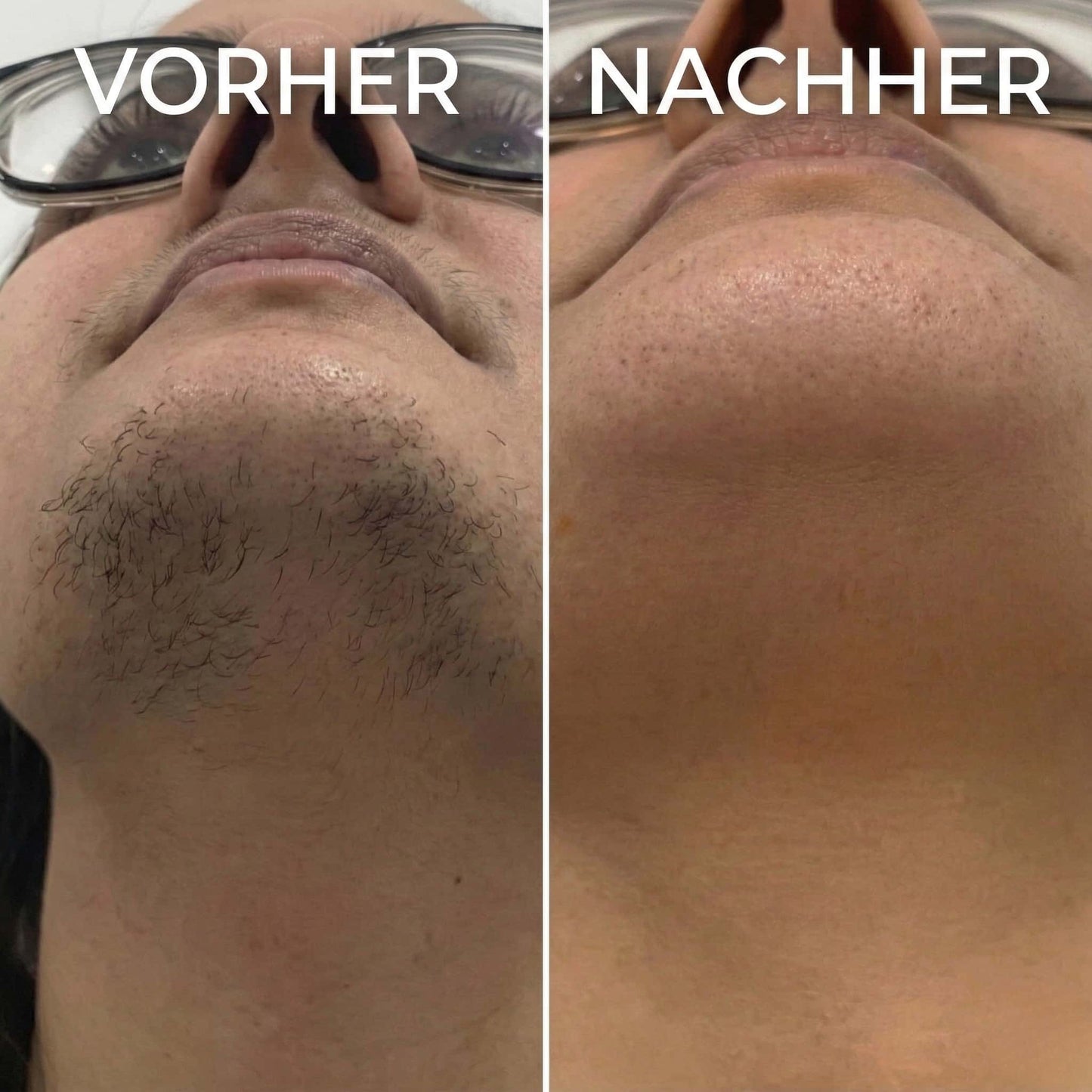 Veluna™ | Pflanzlicher Haarwuchsstopp