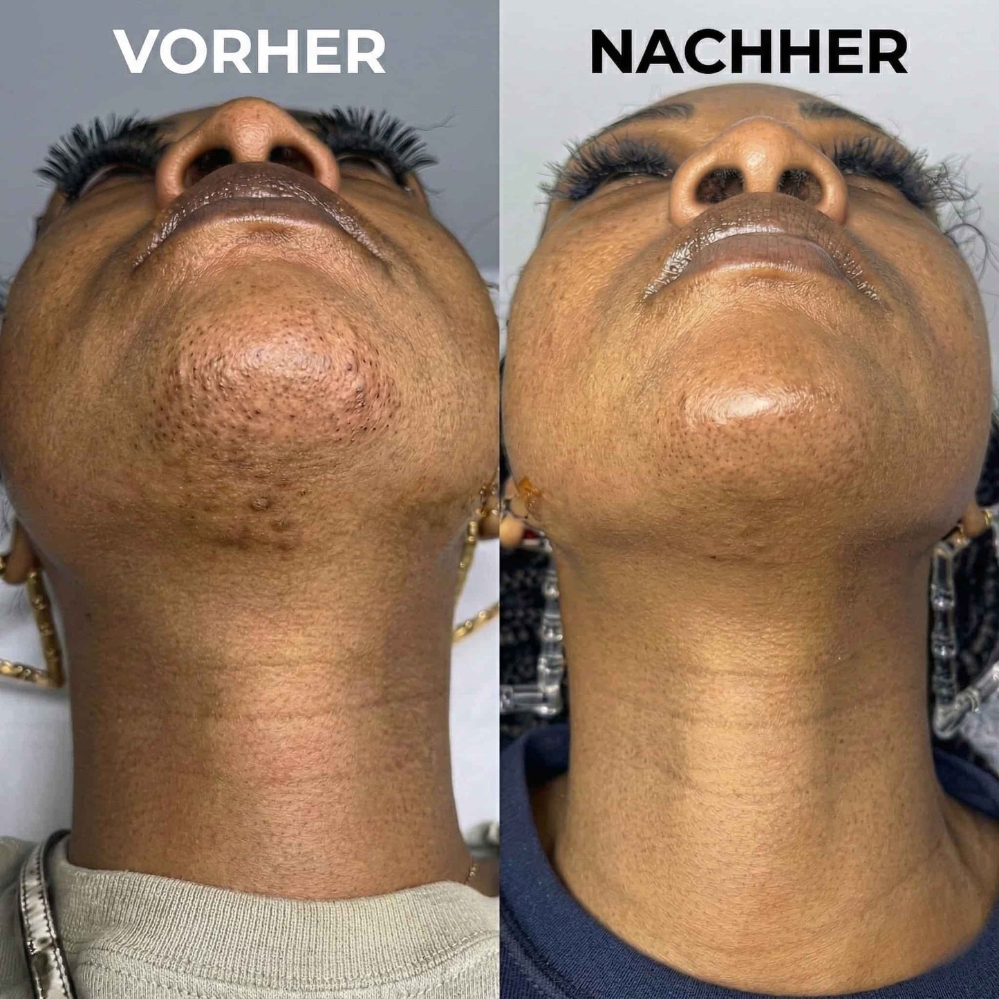 Veluna™ | Pflanzlicher Haarwuchsstopp