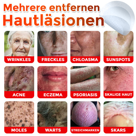 👨🏻⚕️🇩🇪 GFOUK® Mikronadel-Botanisches Hautanhängsel-Entfernungspflaster ✅ Hergestellt in Deutschland