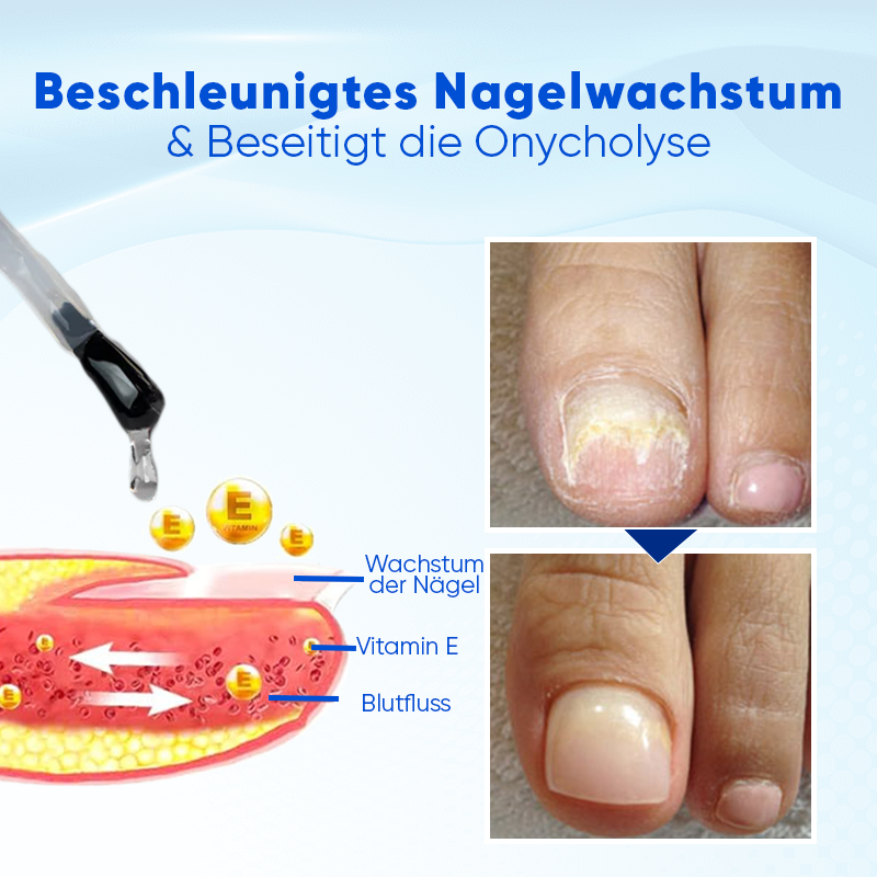 NailViora™ Nagelwachstums- & Reparaturserum – Brüchige Nägel stärken, Onycholyse unterstützen & Nagelwachstum fördern