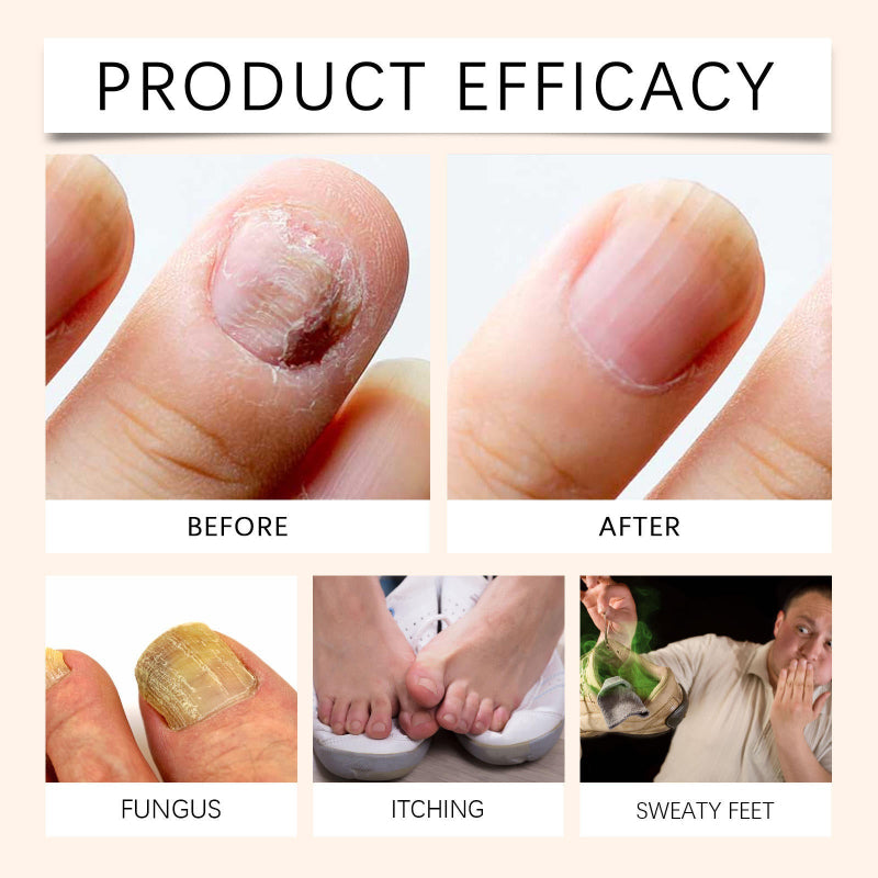 1+1 GRATIS | NailSpray | Einfach Zu Verwendendes Beruhigendes Nagelpflege Reparaturspray