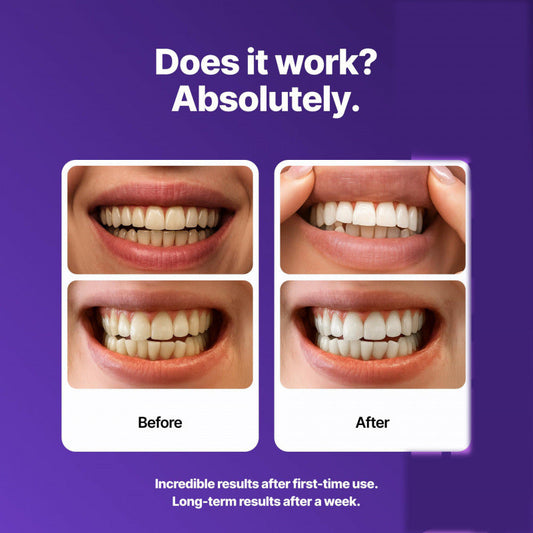 SmileViolet™ Purple Whitening Strips – Für Ein Sichtbar Strahlenderes Lächeln