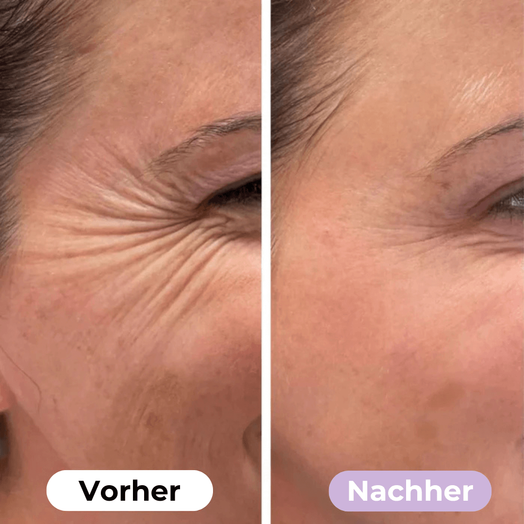 SilkLift™ Anti-Falten Silikonpflaster