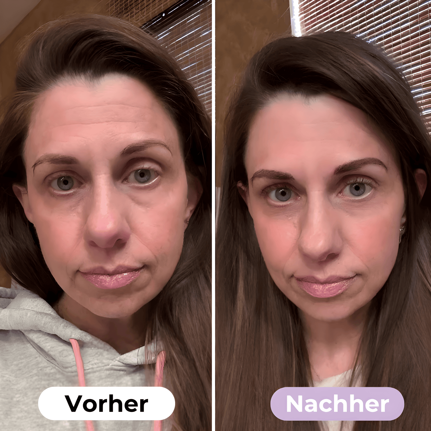 SilkLift™ Anti-Falten Silikonpflaster