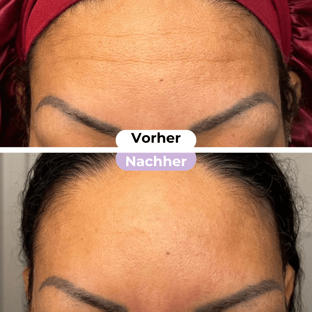 SilkLift™ Anti-Falten Silikonpflaster