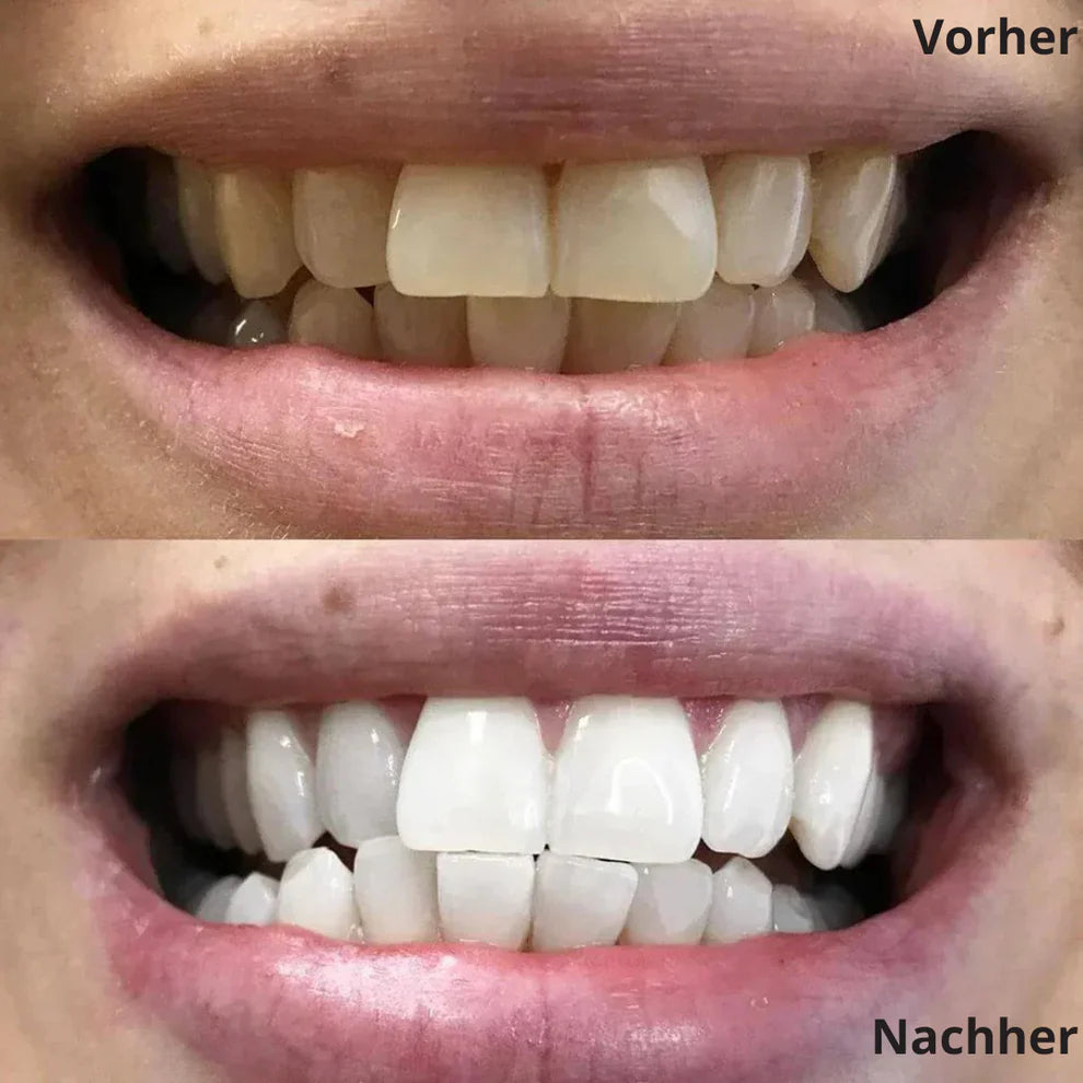 JetSmile™ Professionelles Zahnaufhellungs-Set