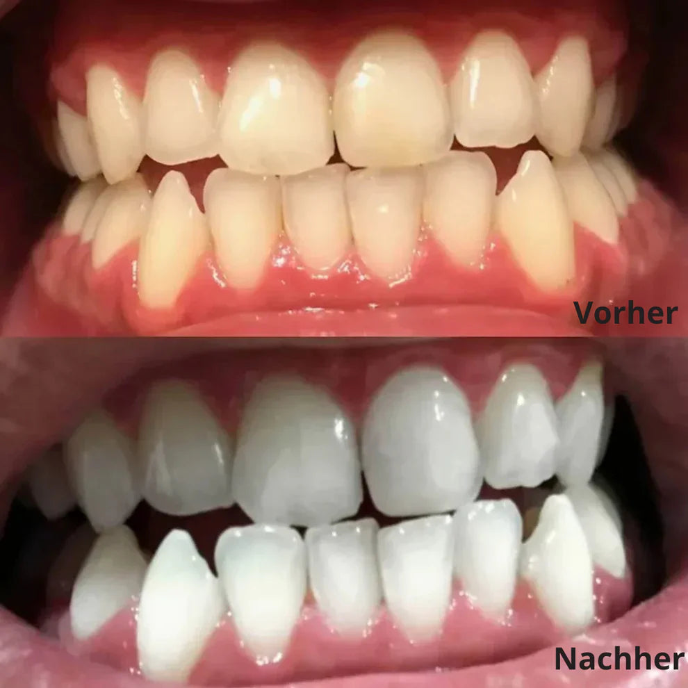 JetSmile™ Professionelles Zahnaufhellungs-Set