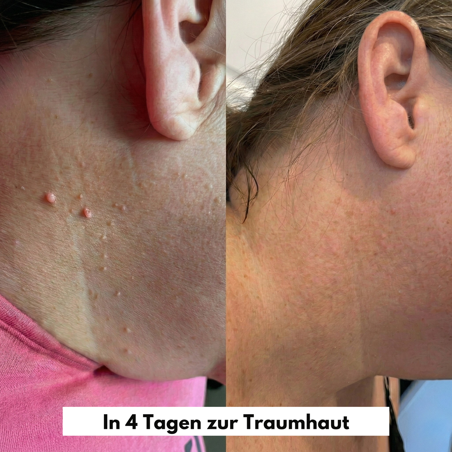 MediClear Plus™ Wieder Wohlfühlen in Deiner Haut
