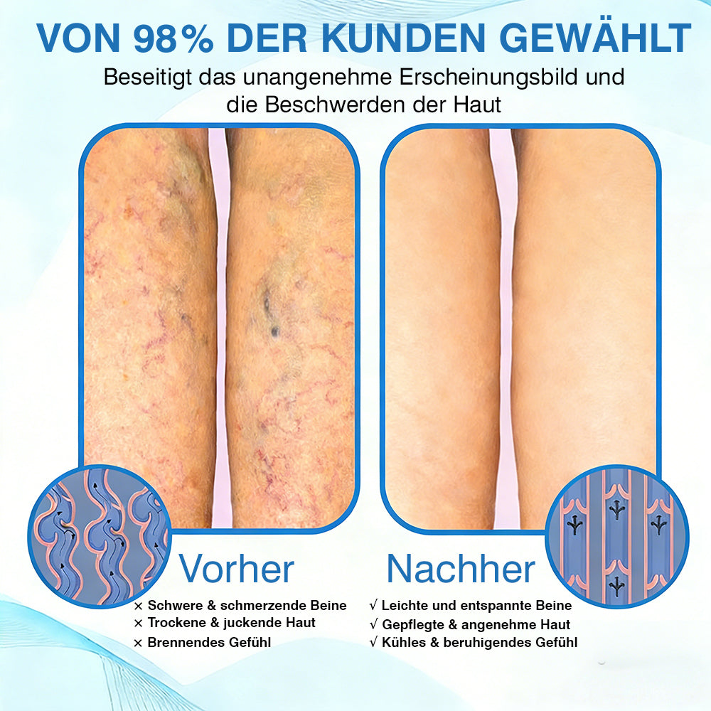 🇩🇪🏃‍🌿GFOUK® VascuCare Vein Healing Spray(Entwickelt für Krampfadern, Besenreiser, tiefe Venenthrombose (TVT), chronische venöse Insuffizienz, venöse Geschwüre, Thrombophlebitis und andere venöse Beschwerden)