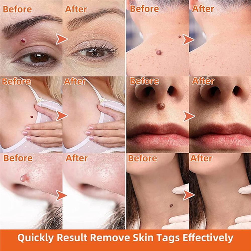 TagFreeza™ Skin Tag Remover – Hautanhängsel schnell, einfach & schmerzfrei entfernen