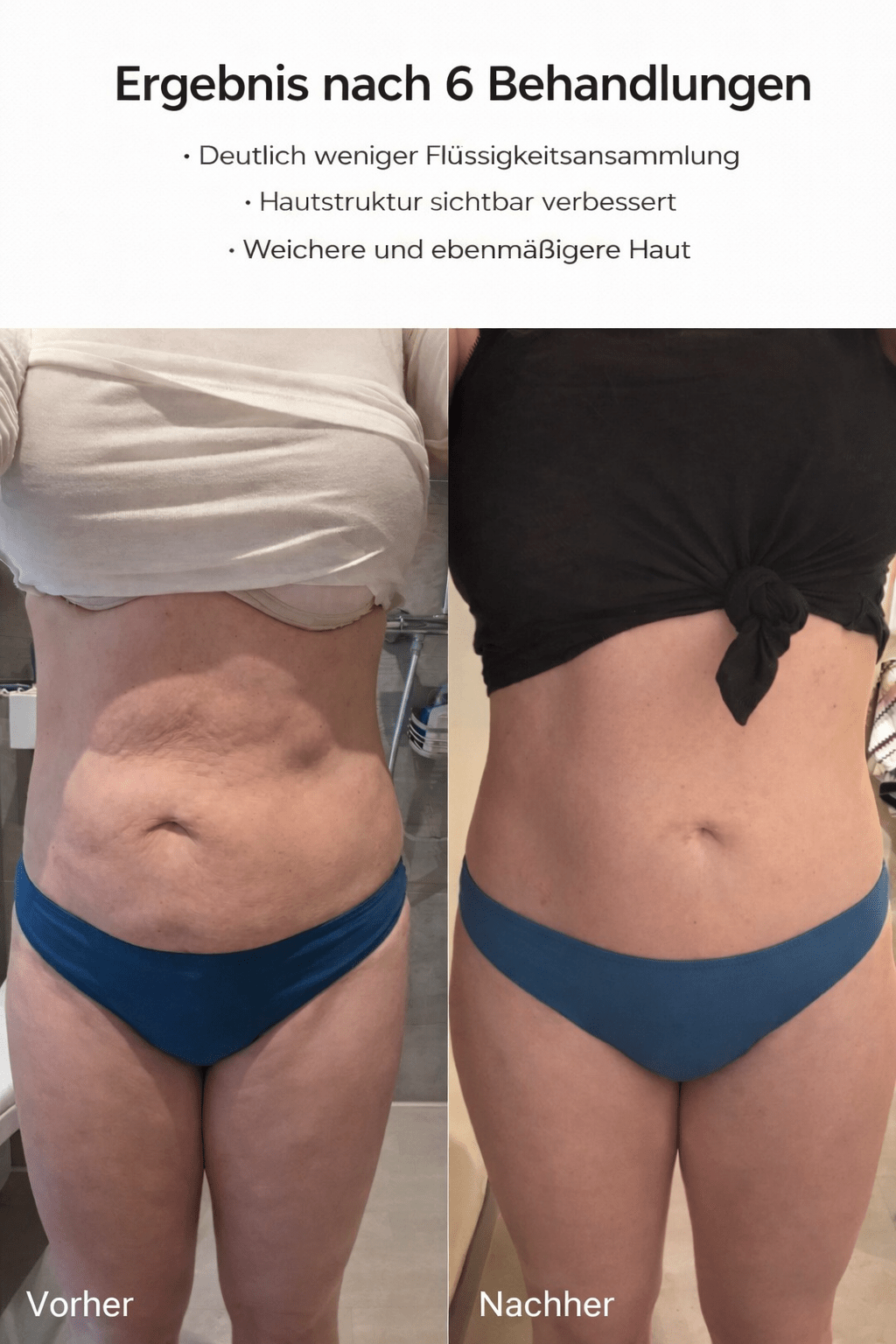 Velunara™ Anti-Cellulite-Massagegerät – Für sichtbar glattere & straffere Haut
