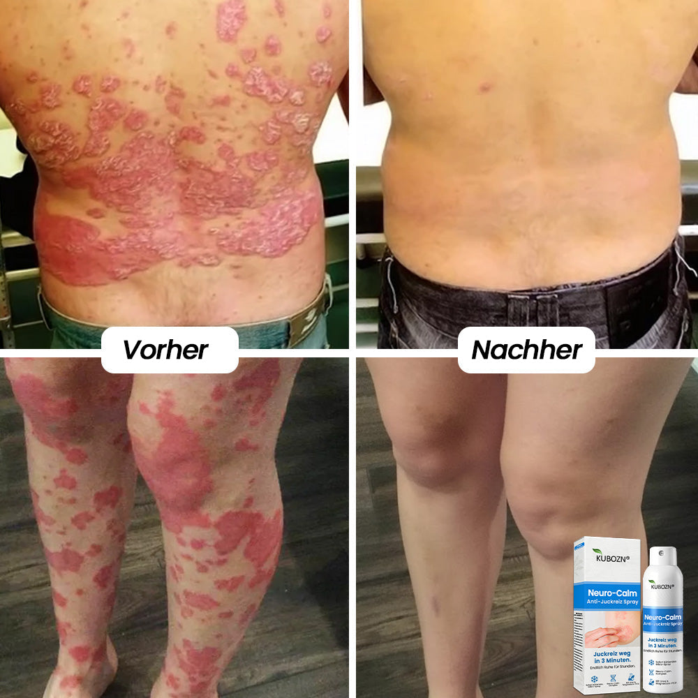 KUBOZN® | Magnesium Kräuter-Spray für Psoriasis-neigende Haut