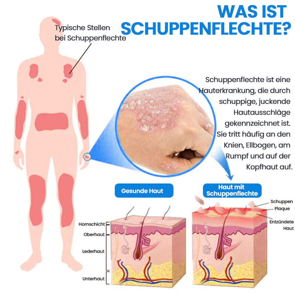 KUBOZN® | Magnesium Kräuter-Spray für Psoriasis-neigende Haut