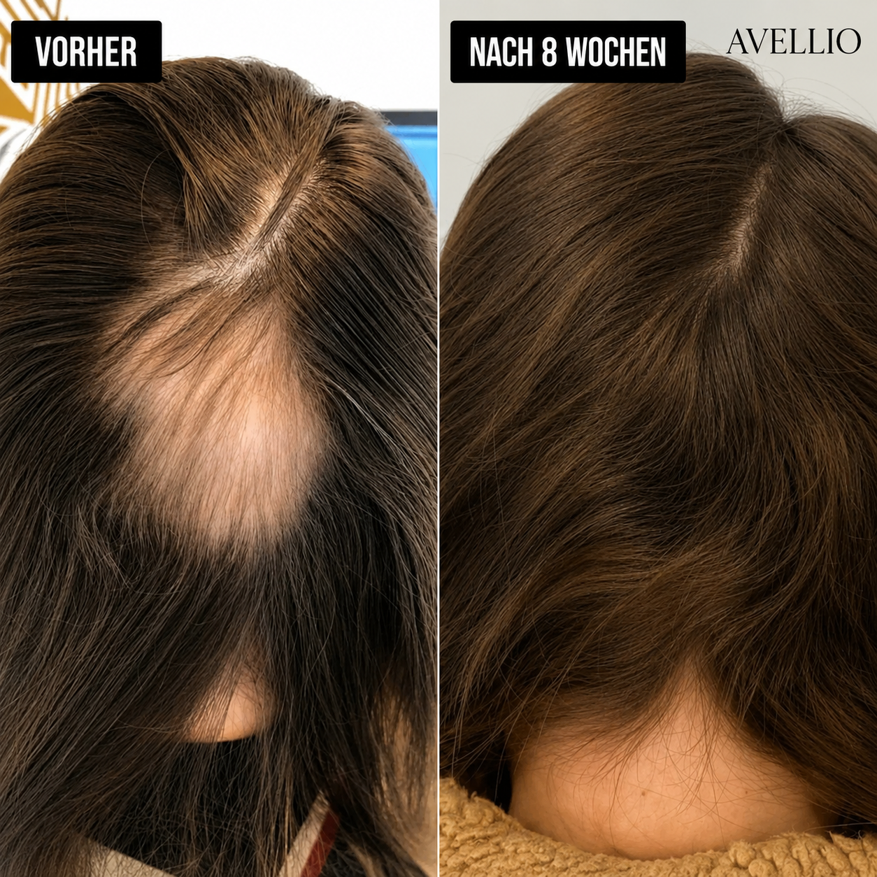 Avellio™ Haarwuchs System