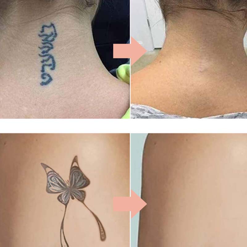 InkLuma™ Tattoo Fade Creme – Für Ein Gleichmäßigeres Verblassen Unerwünschter Tattoos